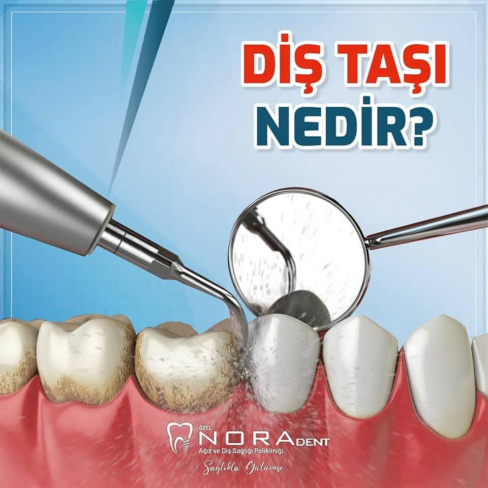 Diş Taşı